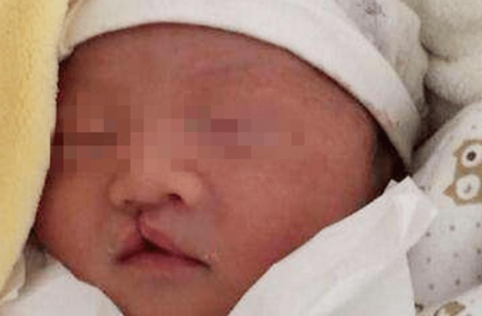 婴儿唇腭裂怎么护理,唇腭裂麻醉