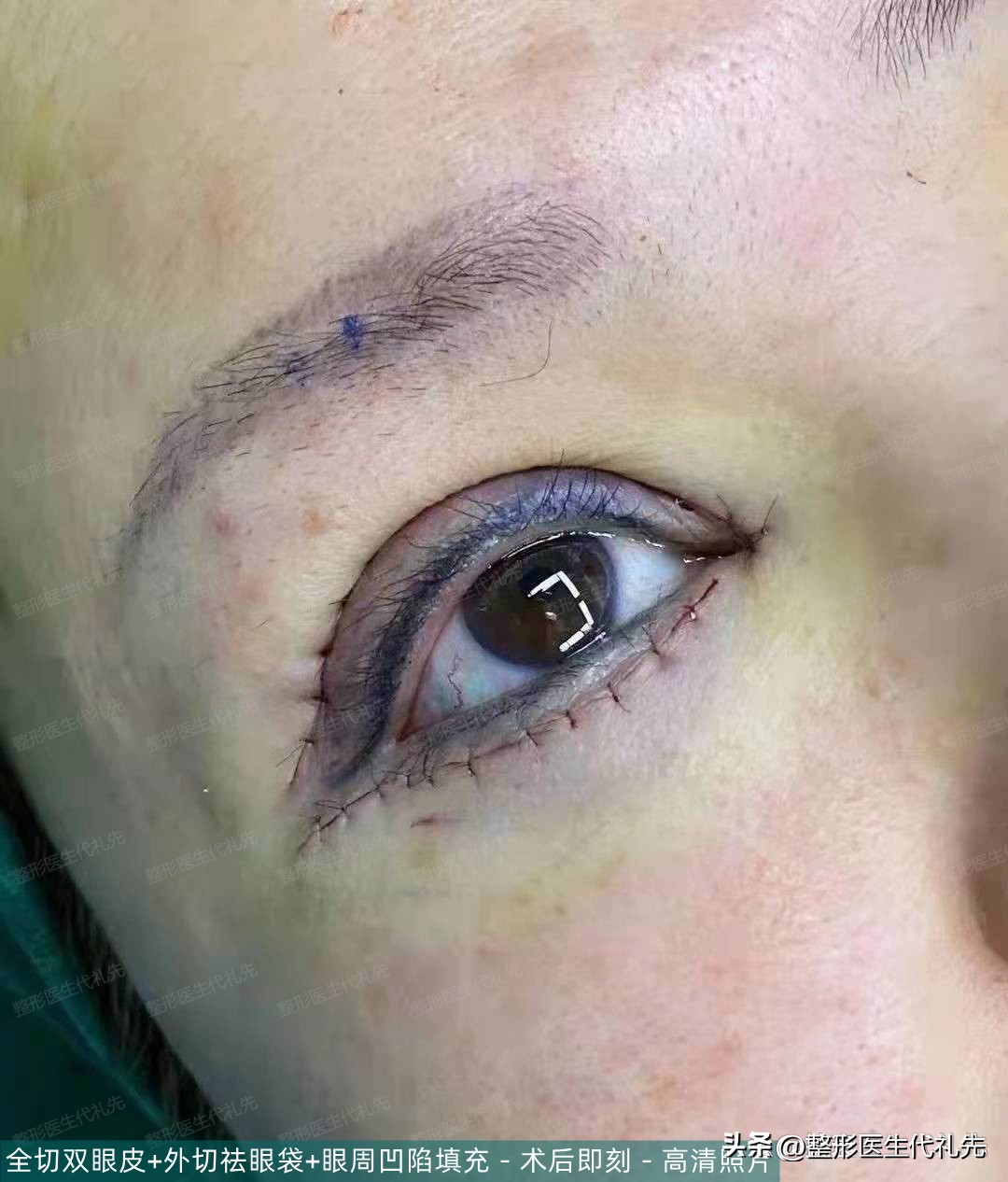 55岁女人割双眼皮之后的视频,40多岁女人做完双眼皮的视频