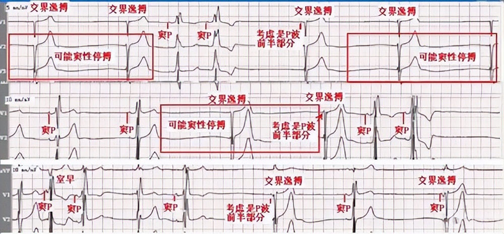 患者男59岁反复胸闷,患者男性59岁因心悸持续一小时