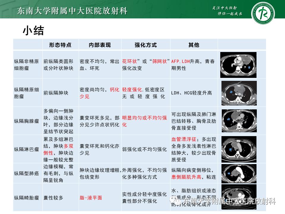 好文分享值得深思,纵隔精原细胞瘤