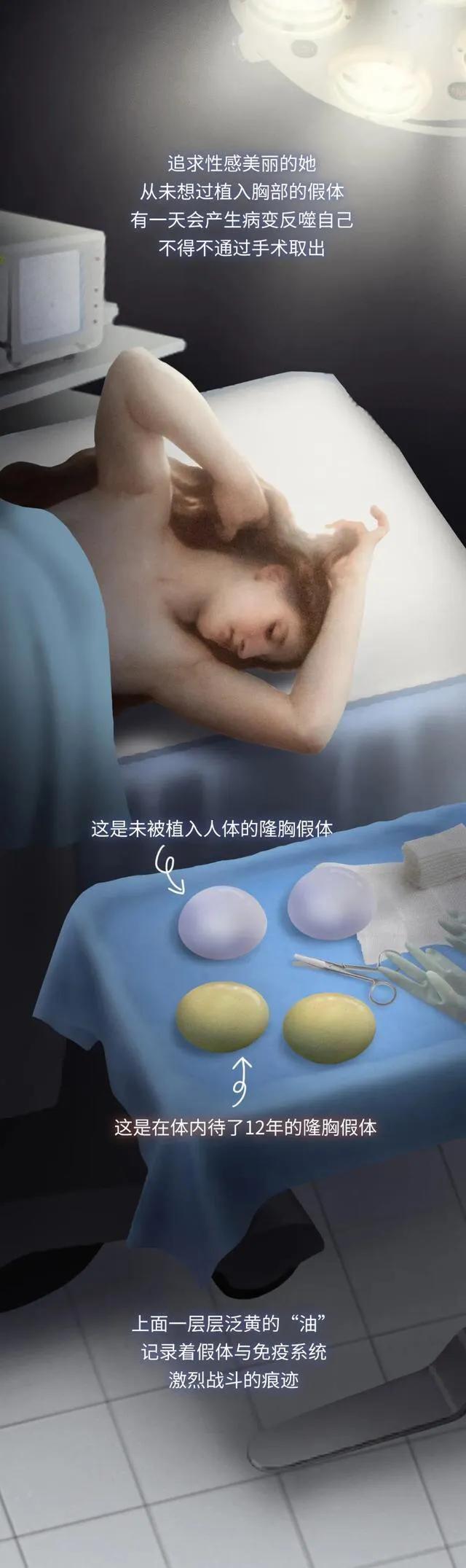 第一个隆胸的女人,全球最红隆胸女人