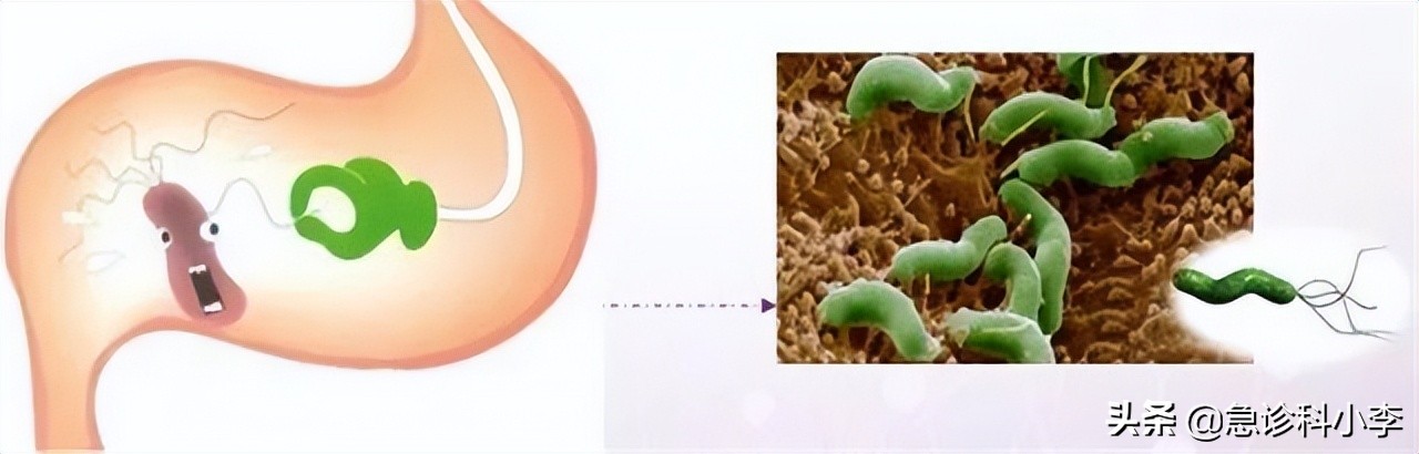 幽门螺杆菌是胃病的罪魁祸首吗,幽门螺杆菌一直治不好怎么办