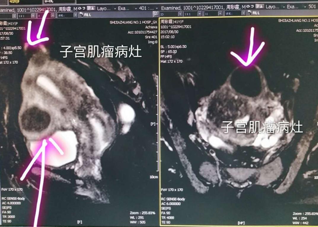 子宫肌瘤变小的三大克星,子宫肌瘤中医治疗肌瘤能缩小吗