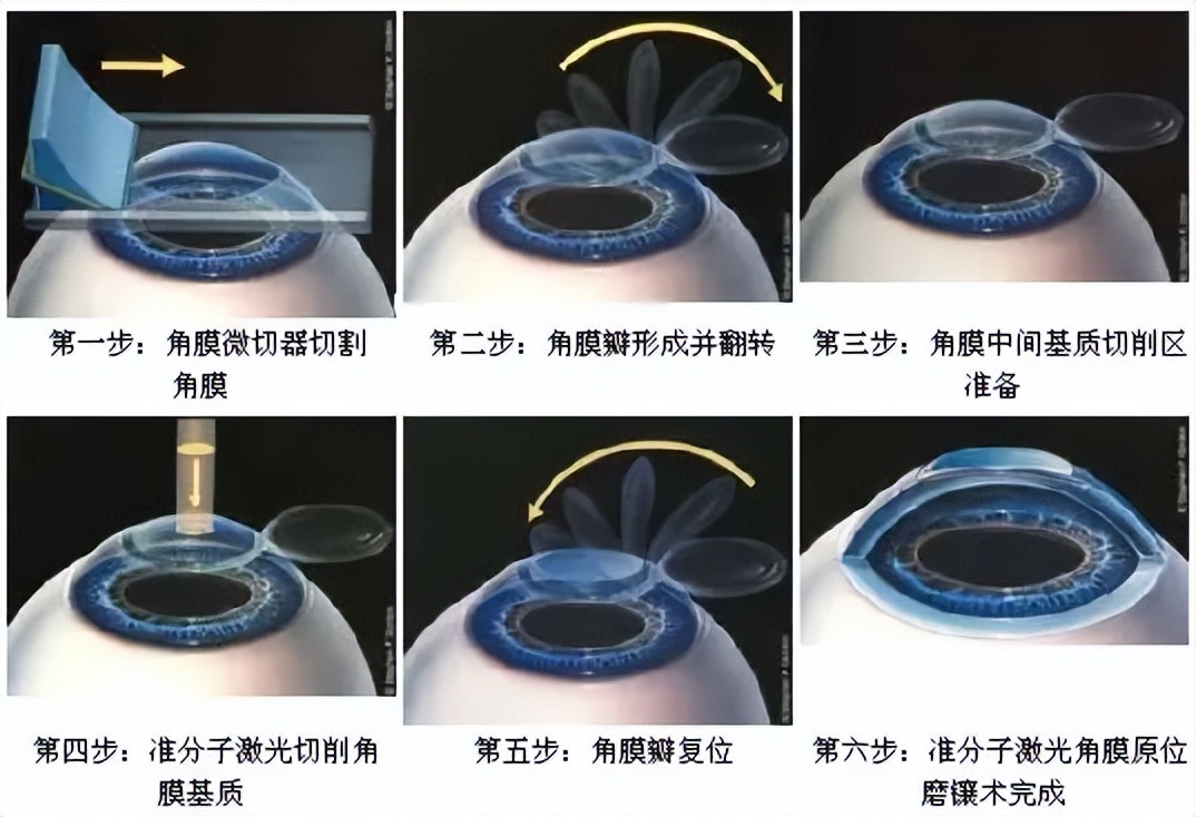 准分子近视手术副作用,准分子近视眼手术价格多少