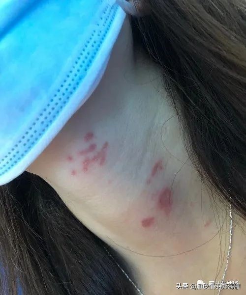 九月初预警：隐翅虫年度盛典，奇怪皮炎频现，教您如何躲着点