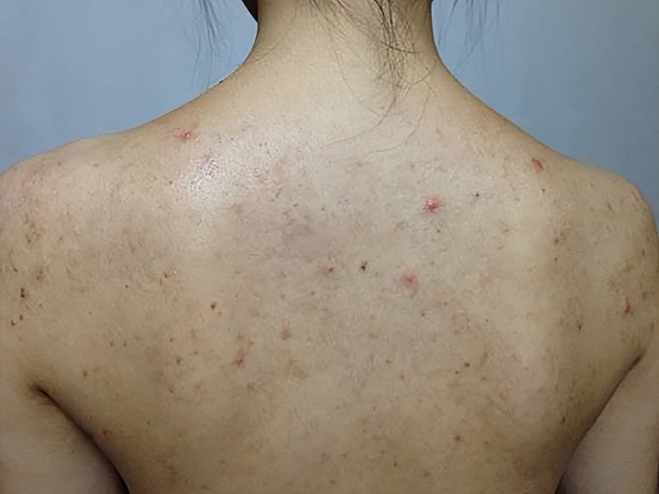 广州一女子坚持用硫磺皂水洗头,湖南校花坚持用硫磺皂洗头