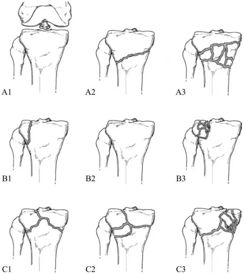 胫骨平台骨折分型及治疗ppt,胫骨平台骨折保守治疗可以评几级