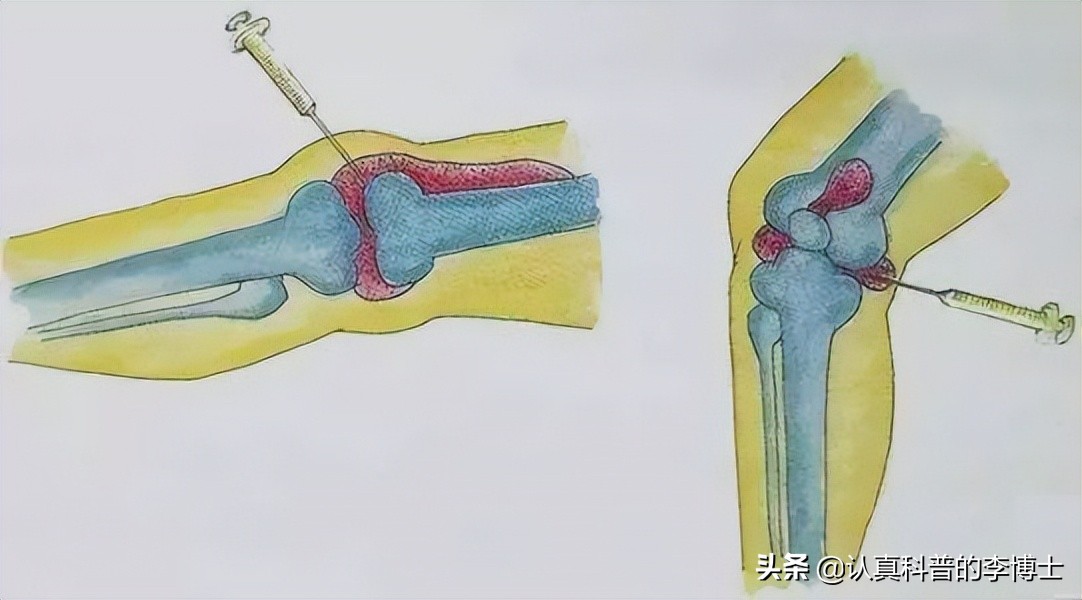 关节有积液需要抽吗,抽关节积液有什么危害