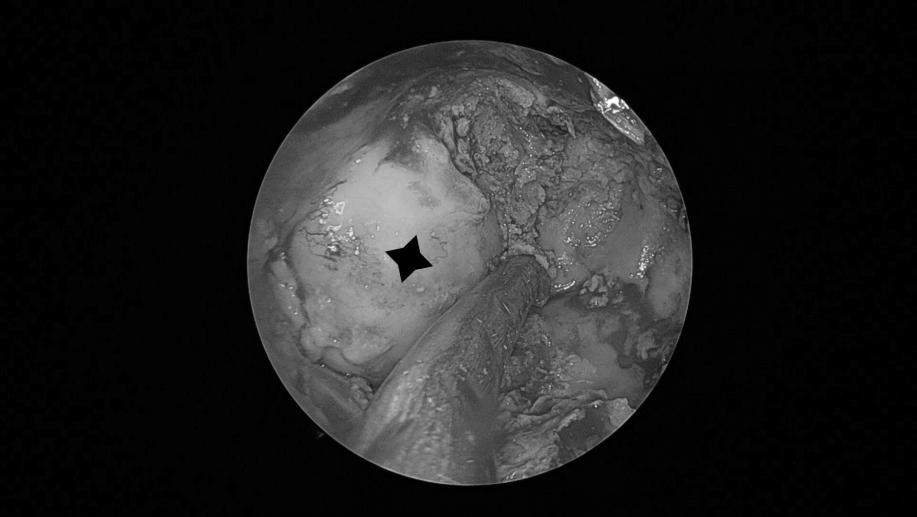 南昌二附院耳鼻喉科手术,南昌大学第二附属医院耳鼻咽喉科