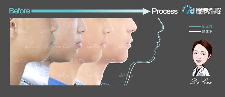 儿童反颌矫正完嘴凸,儿童下颌后缩嘴凸矫正需要多久