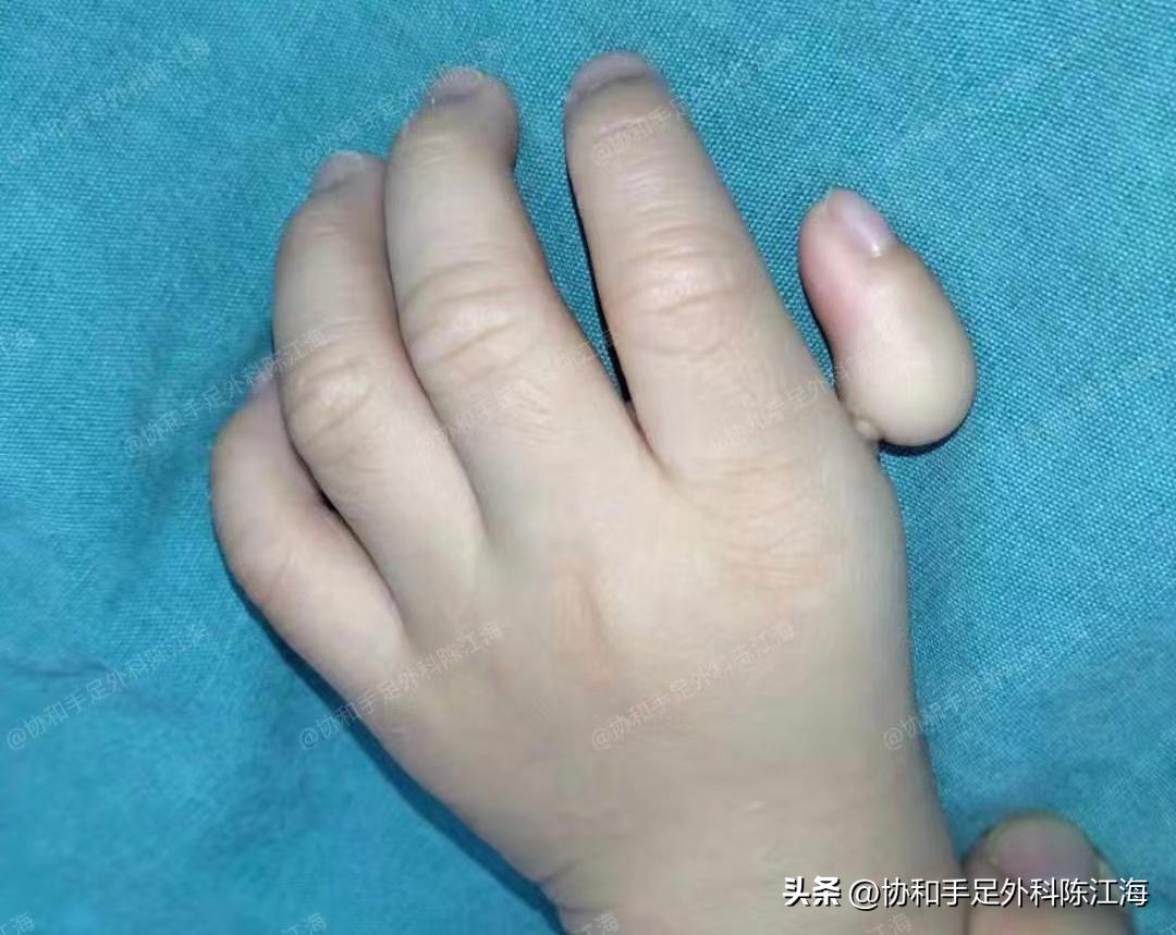 漂浮拇指治愈后样子,漂浮拇指治愈后图片