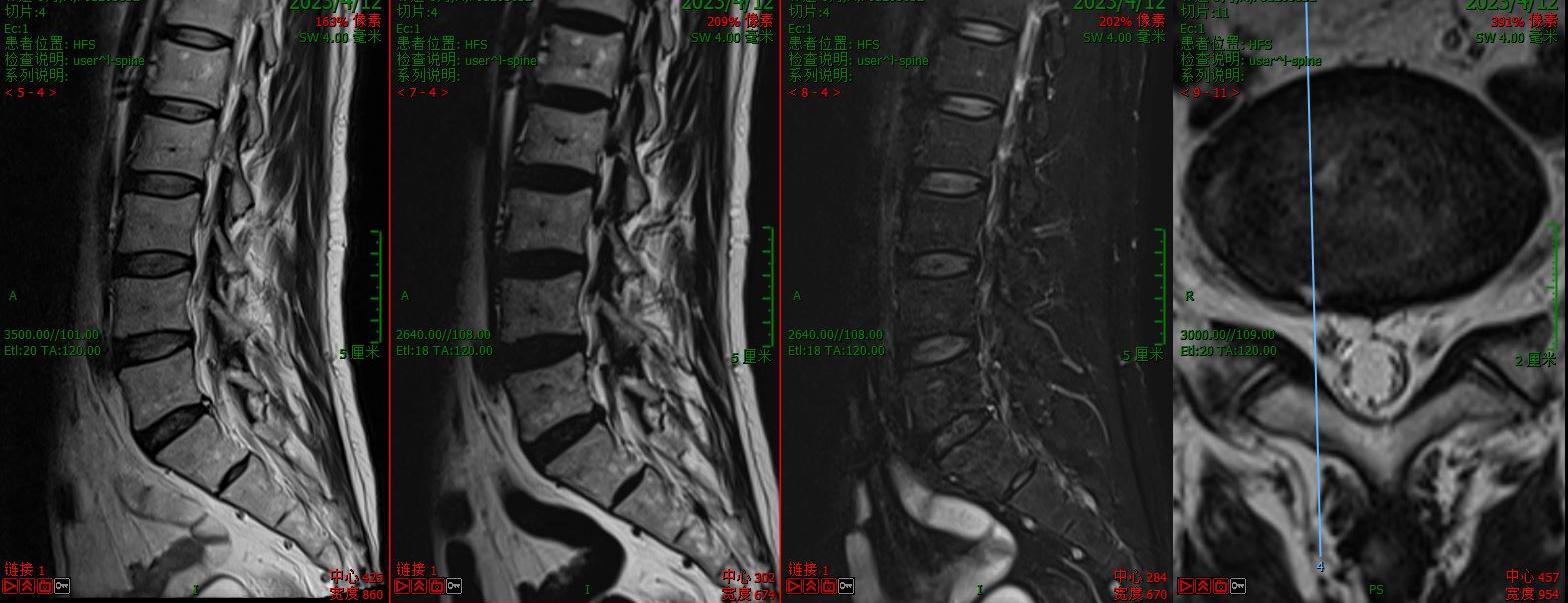 在中原地区正式开展！河南省洛阳正骨医院为两例腰椎疾病患者成功实施V形双通道脊柱内镜技术（VBE）