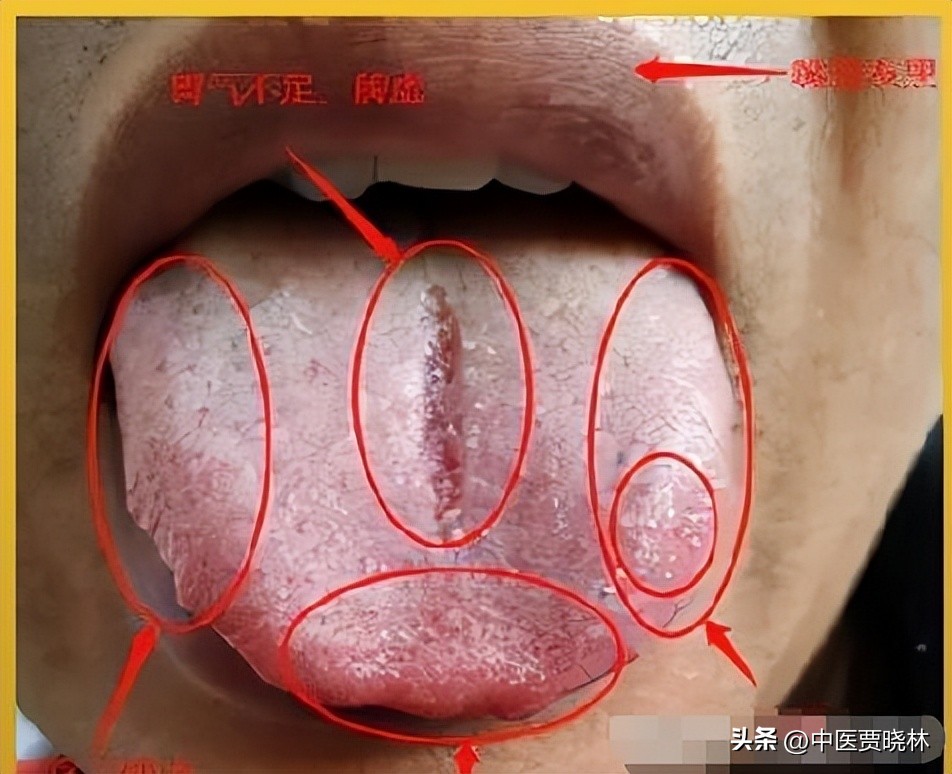 舌有齿痕属于哪一种湿气,舌边有齿痕一定是体内湿气吗