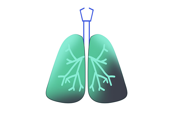一级致癌物石棉是什么东西,石棉为什么被列为致癌物