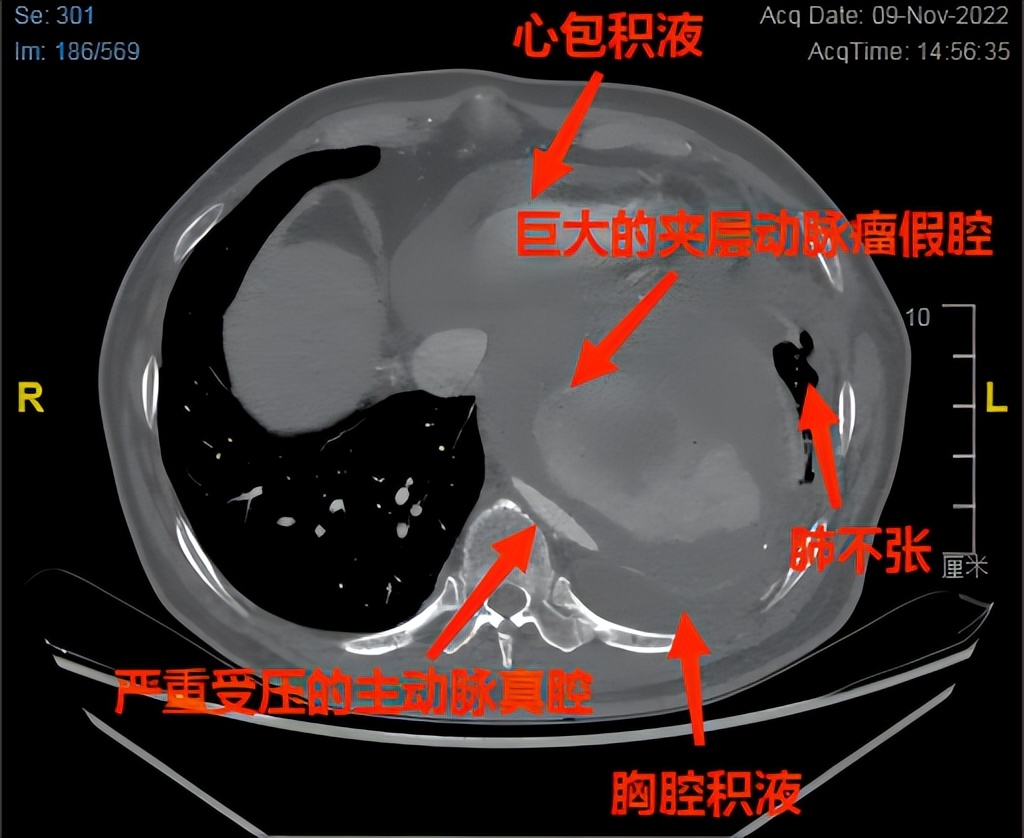 南昌大学二附院血管介入科,南昌二附院血管外科主动脉血管瘤
