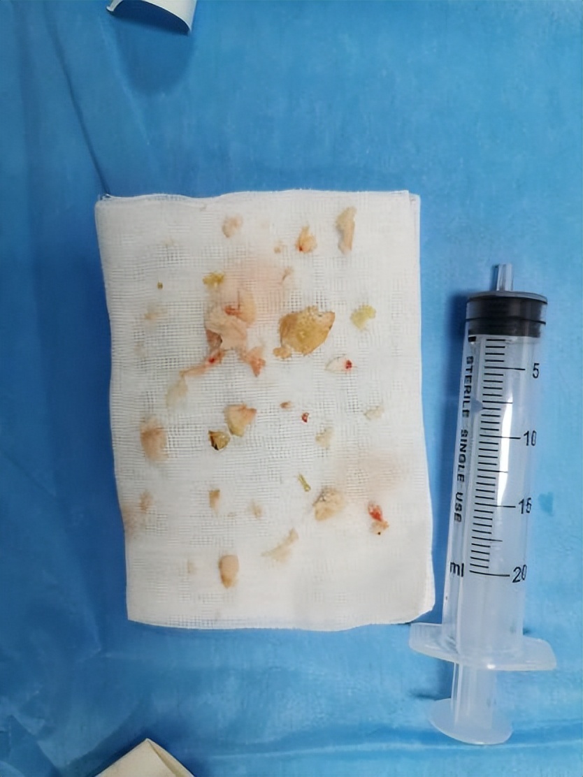 腰椎间盘突出微创姑息法,38岁腰椎间盘突出微创