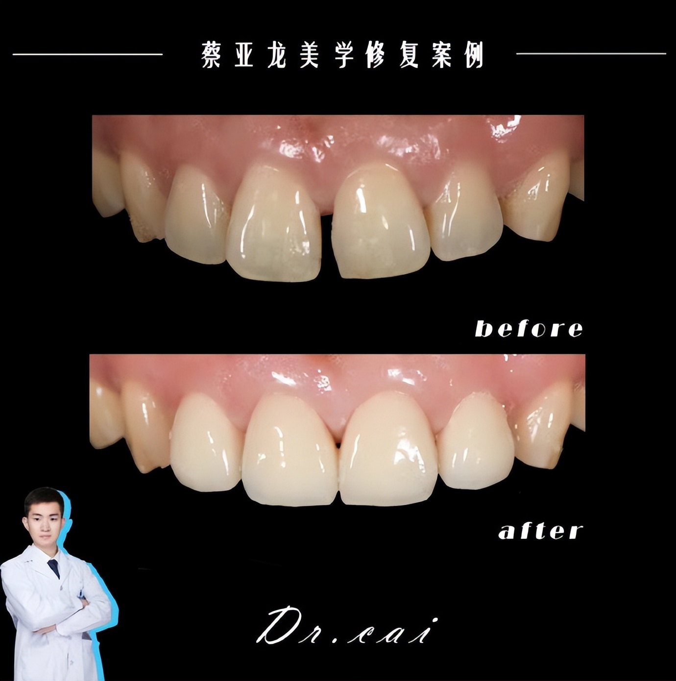 贵阳门牙牙缝大牙齿矫正,长沙牙齿疏松缝隙大矫正