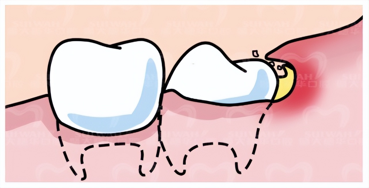 吃东西老是塞牙缝怎么解决,吃东西经常塞牙齿