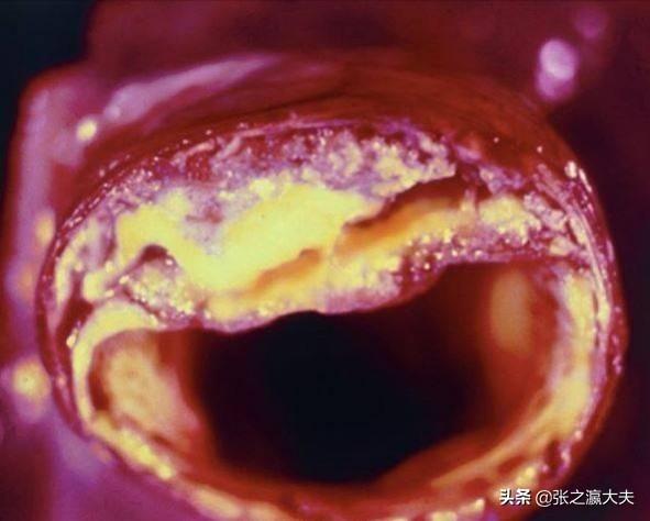 低压高的症状和危害,低压高为什么更可怕