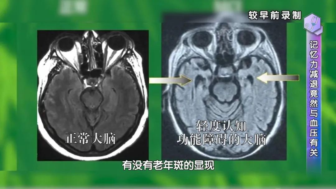 吃核桃能预防老年痴呆,常吃核桃能够延缓大脑的衰老吗