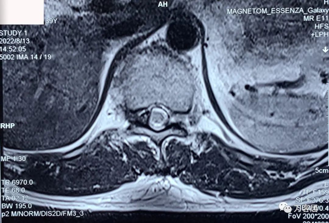 良性单侧下肢肌萎缩,下肢肌肉萎缩24年能治好吗
