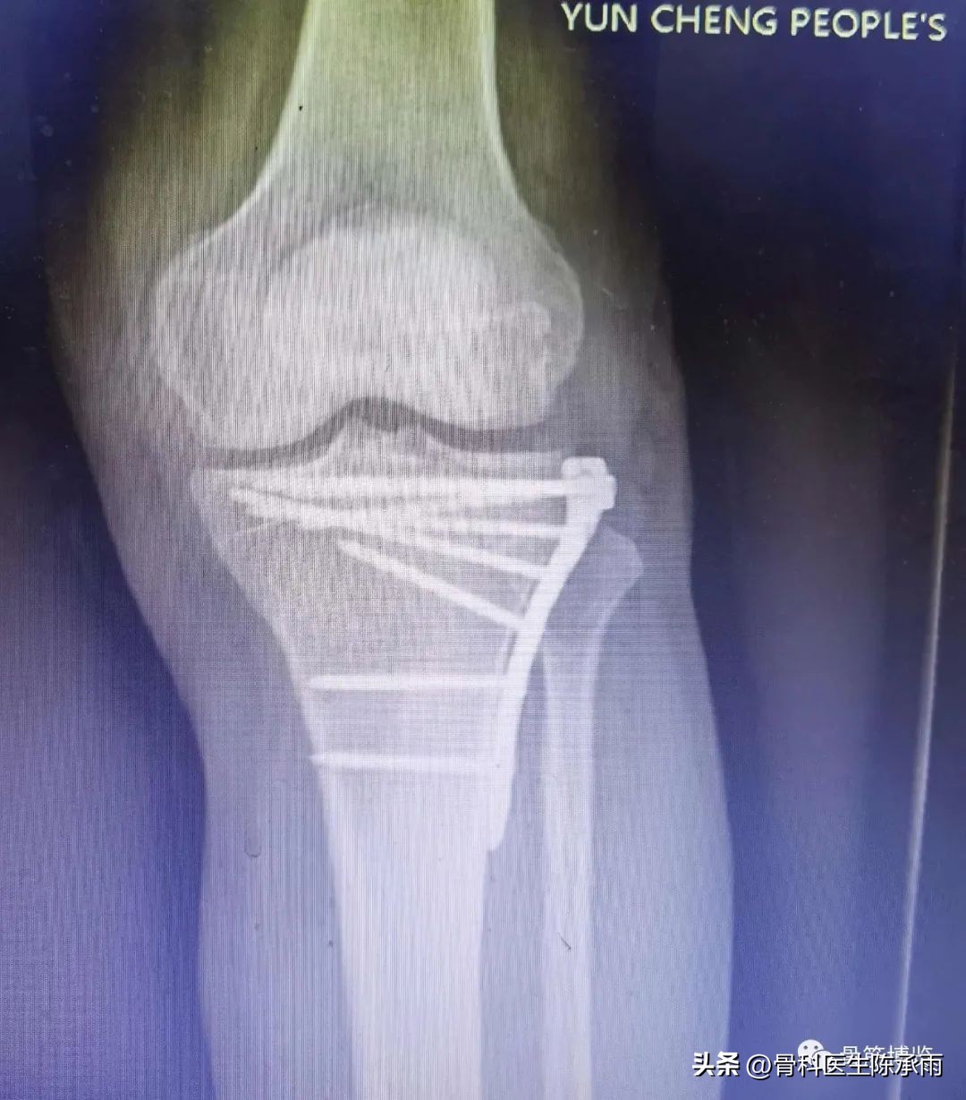 膝关节胫骨平台骨折,最近胫骨平台骨折视频