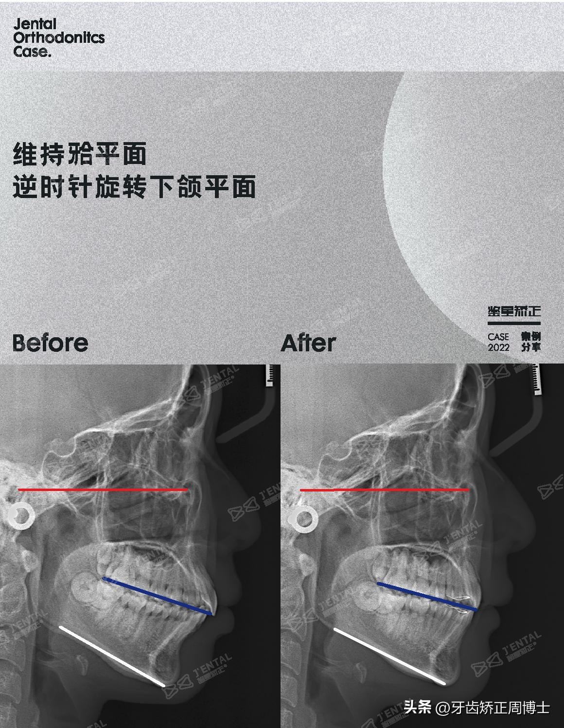 骨性龅牙矫正牙齿变小了,骨性龅牙已经做了正畸手术怎么办