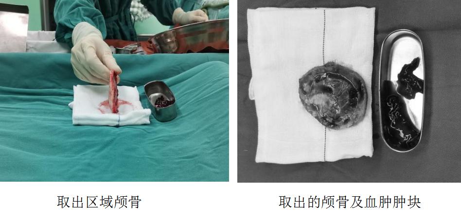 飞来横祸轮胎砸中脑袋,一男孩被铅球砸严重骨折