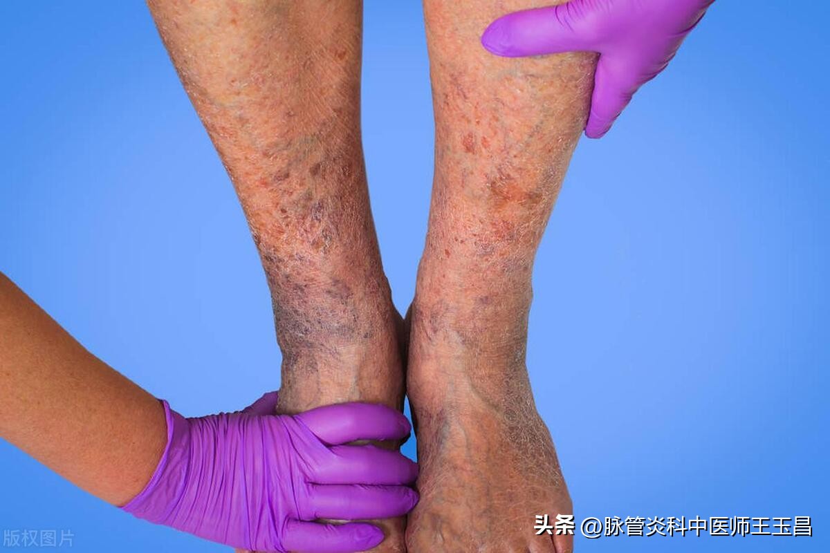 浅表性静脉炎中医怎么治疗,中医怎么治疗静脉炎