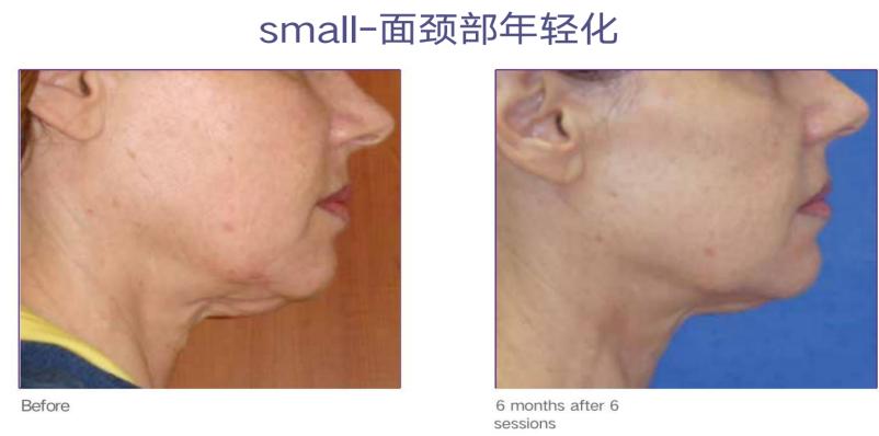 美迪迈相控微针是什么,美迪迈相控微针多久能化妆