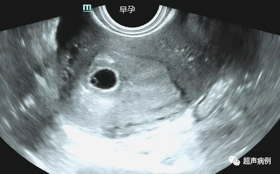 做阴道B超是一种什么样的体验？