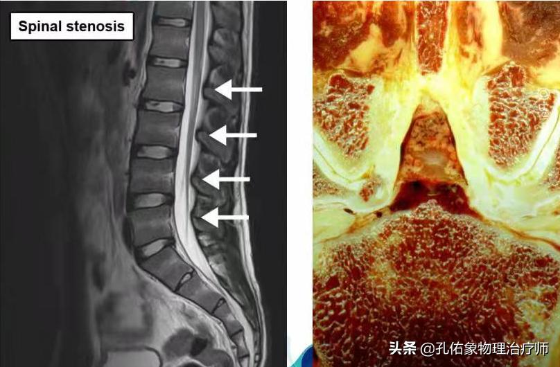 腰椎管狭窄引起的腰腿疼怎么办,腰椎管狭窄引起腰痛腿痛怎么办