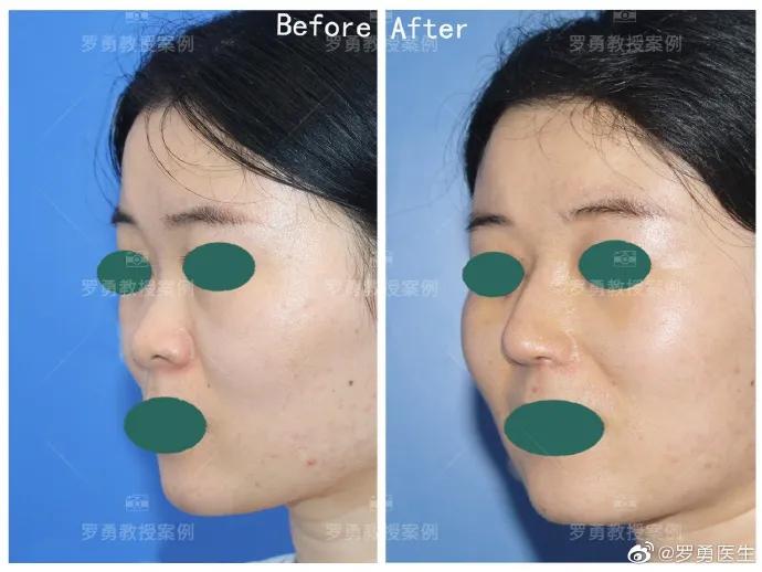 鼻综合鼻头挛缩山根太高怎么修复,鼻综合后山根太低