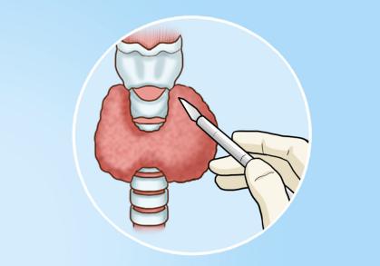 i甲,早期甲癌全切会痊愈吗