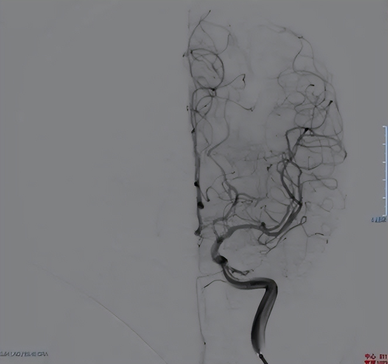 首创国内ICAS多模态评估体系开创脑血管领域精准诊疗新纪元