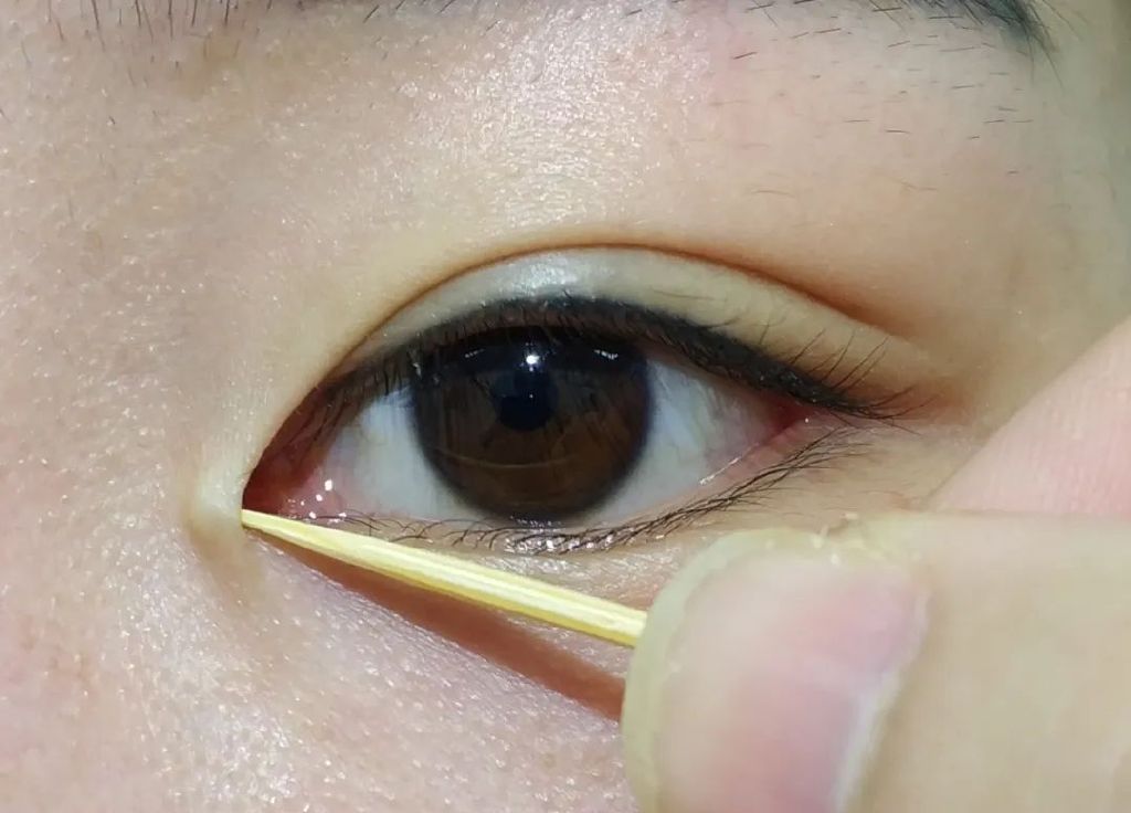 开外眼角优点和缺点,外眼角开的不明显还可以再开吗