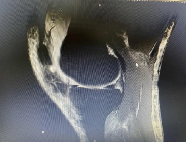 prp治疗膝关节退行性关节炎,骨性膝关节炎注射prp有效果吗