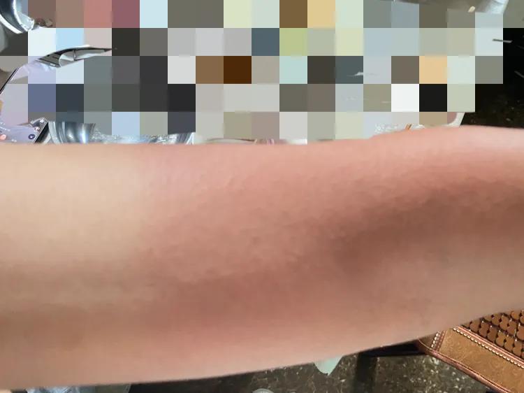 皮肤晒伤晒红怎么修复快速变白,晒红晒伤后怎么能快速修复