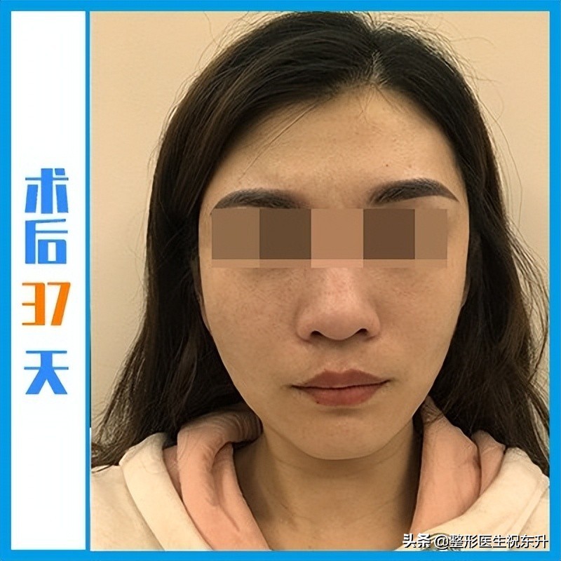 拉皮手术面诊,华西拉皮手术面诊后多长时间手术