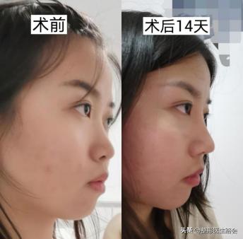 什么样的人做了鼻子变化大,做的鼻子和真鼻子区别大吗