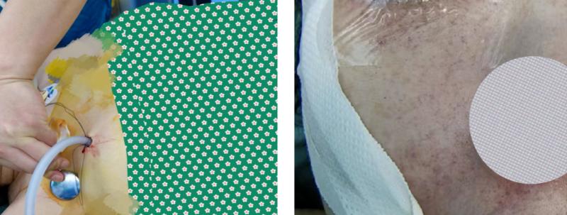 麻醉期间气道梗阻,手术后呼吸急促是什么原因