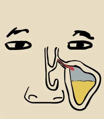 鼻窦发炎眼睛会持续疼还是偶尔疼,为什么得了鼻窦炎头很疼