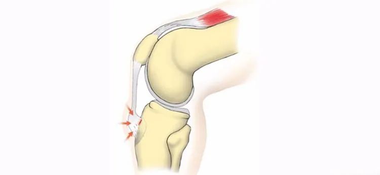 膝盖前面肿了一个包,孩子膝盖上长了一个疙瘩