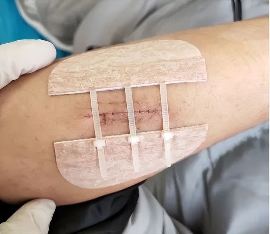 受伤后千万不要抠结痂,受伤了希望不要留下疤痕