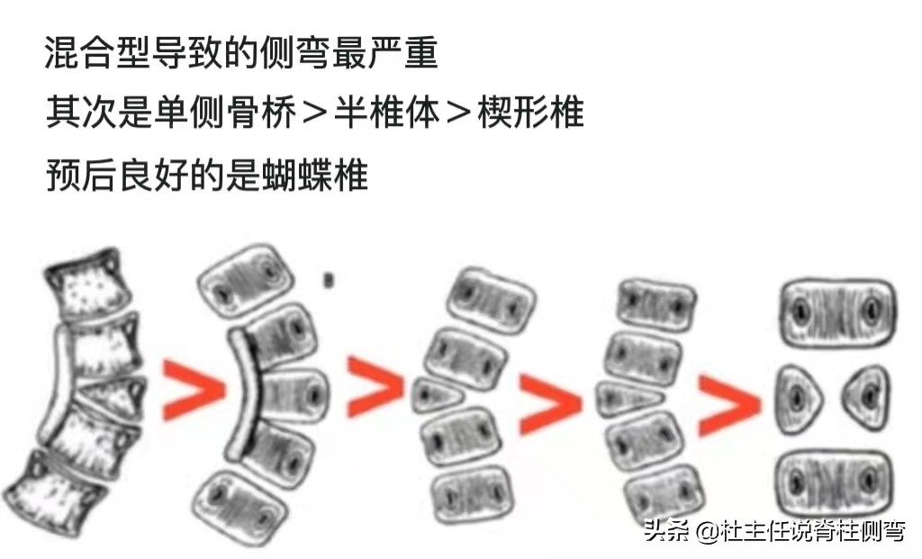 什么是先天性脊柱侧弯,先天性脊柱侧弯手术费用报销吗