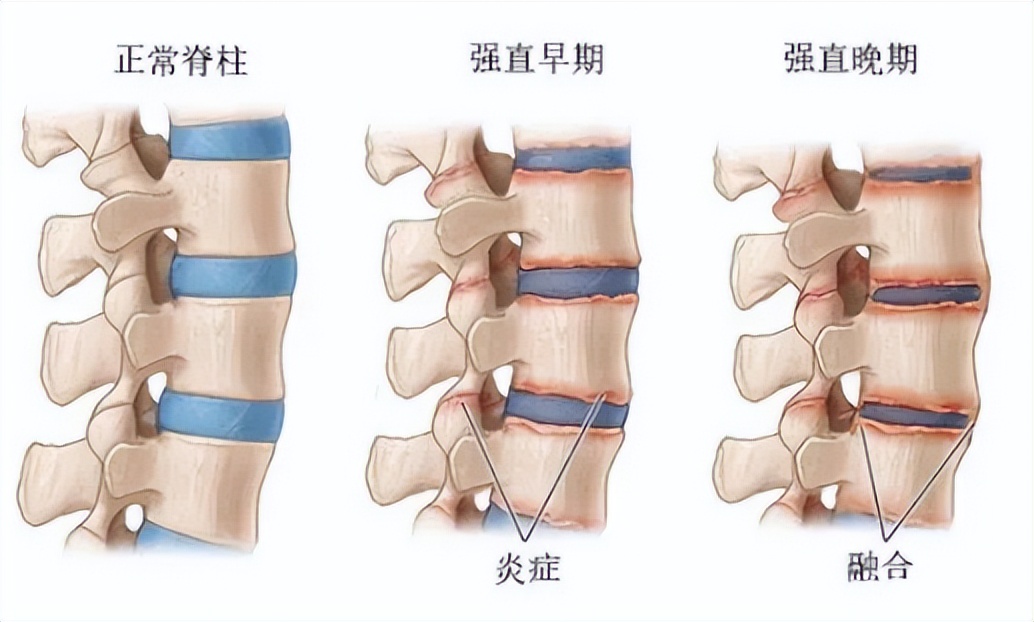 如何判断自己是腰肌劳损还是强直,腰腿疼痛是不是跟腰肌劳损有关系