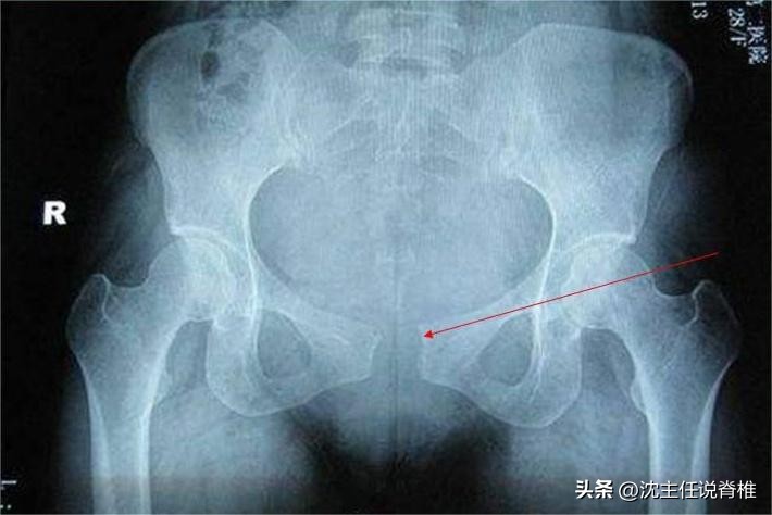 孕妈耻骨疼怎么办,孕期耻骨联合分离缓解办法