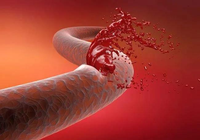 80岁老人脑出血家人放弃医生哭了,老人脑出血家属拒绝手术医生落泪