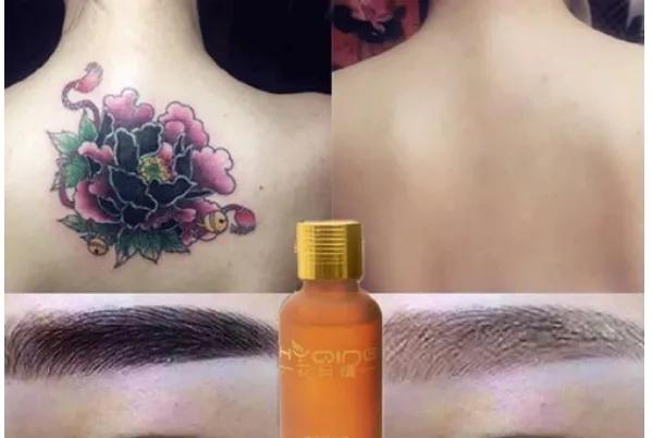 洗纹身真的不是一般人能承受的,洗纹身真的要下很大的决心