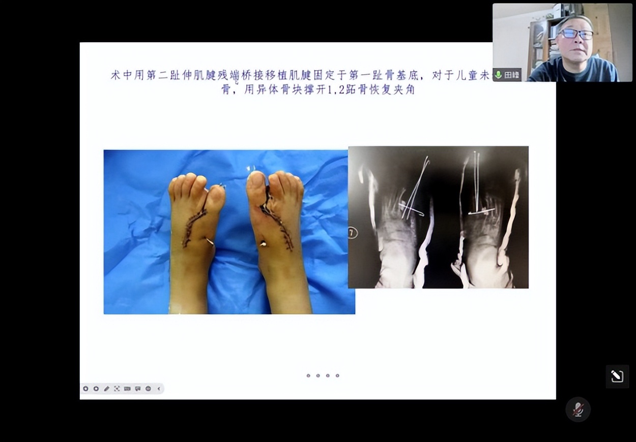 2022年足踝外科康复医学会议,创面修复学术研讨会